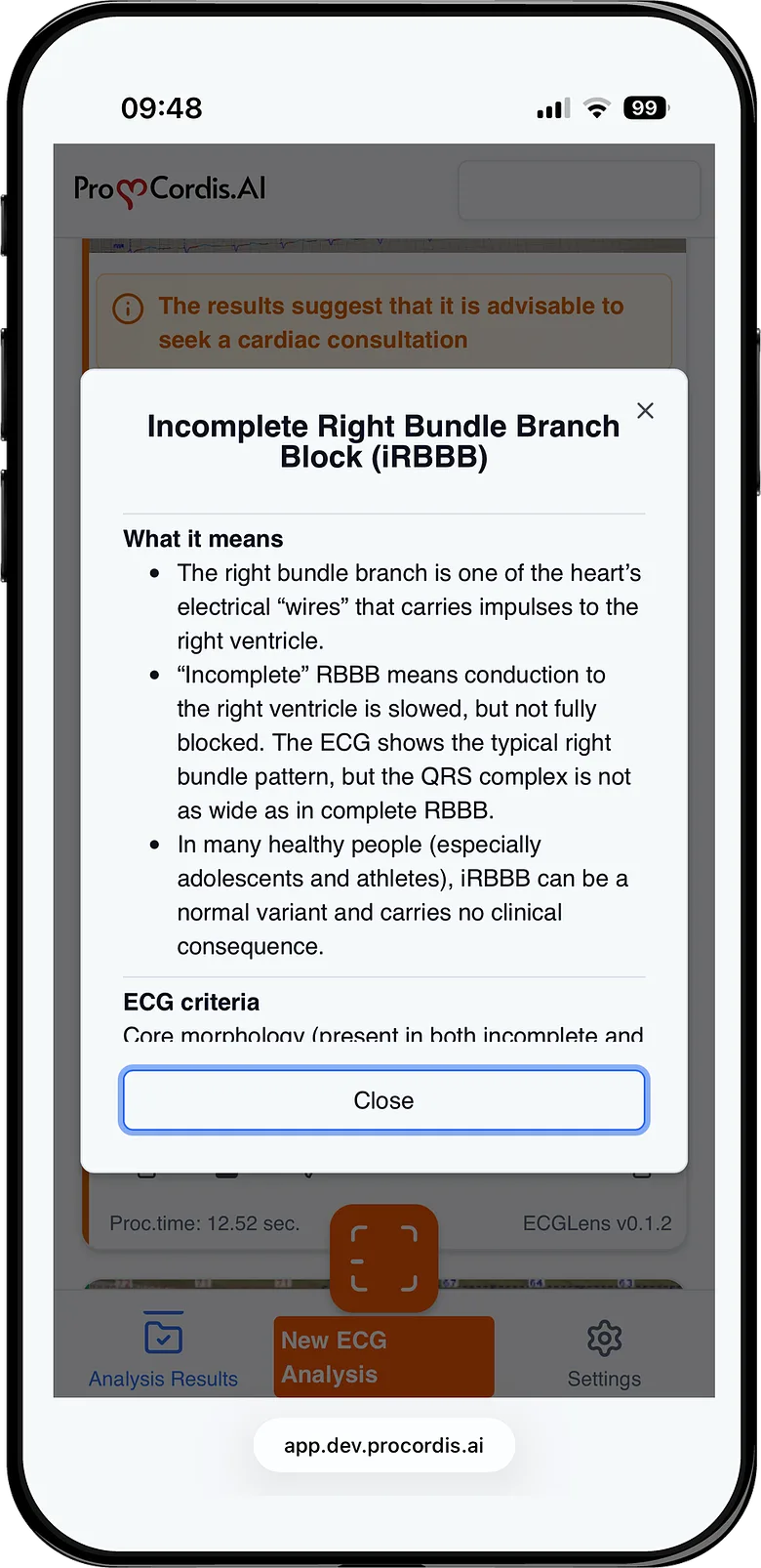 In-app explainer describing incomplete right bundle branch block